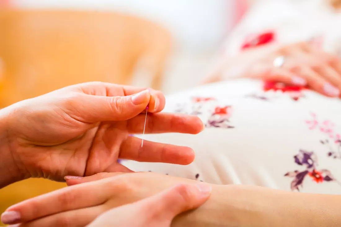 Acupuncture during pregnancy in Miami — photo of a pregnant woman undergoing acupuncture — American Butler