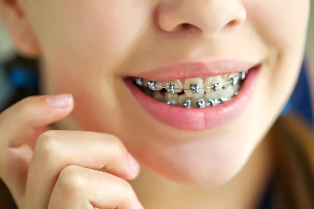 Miami dentists — teeth straightening and alignment, implantation